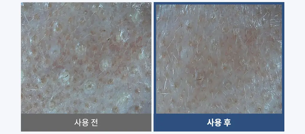 [블랙헤드관리/김다혜PICK] 비프로젝트 바이 블랙헤드 멜팅 리무버 30ml 상세페이지 41
